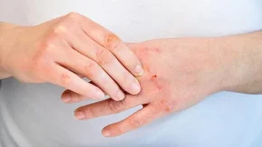 بیماری خود ایمنی پوستی چیست|آیا علائم بیماری خود ایمنی پسوریازیس با HIV یکسان است؟