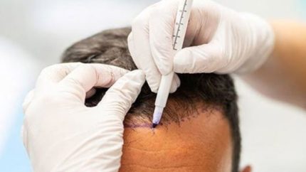 کاشت موی طبیعی در تهران با ضمانت